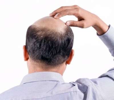 بهترین مرکز کاشت مو در یزد چه شرایطی باید داشته باشد؟